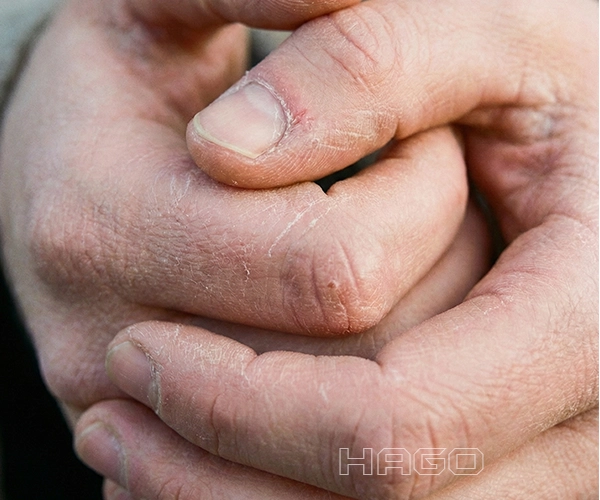 Hilfe bei rauer und rissiger Haut